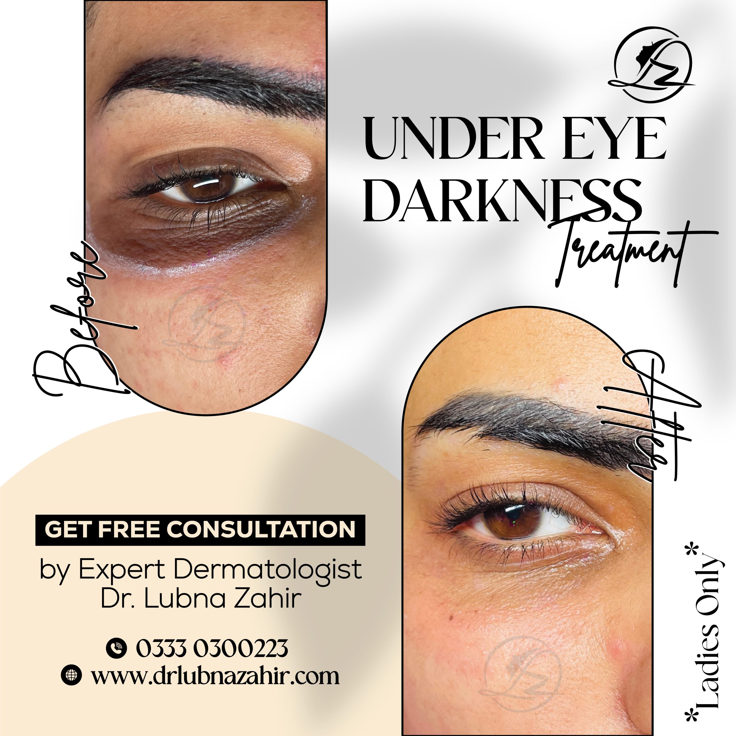 Under Eye Darkness treatment in islamabad
