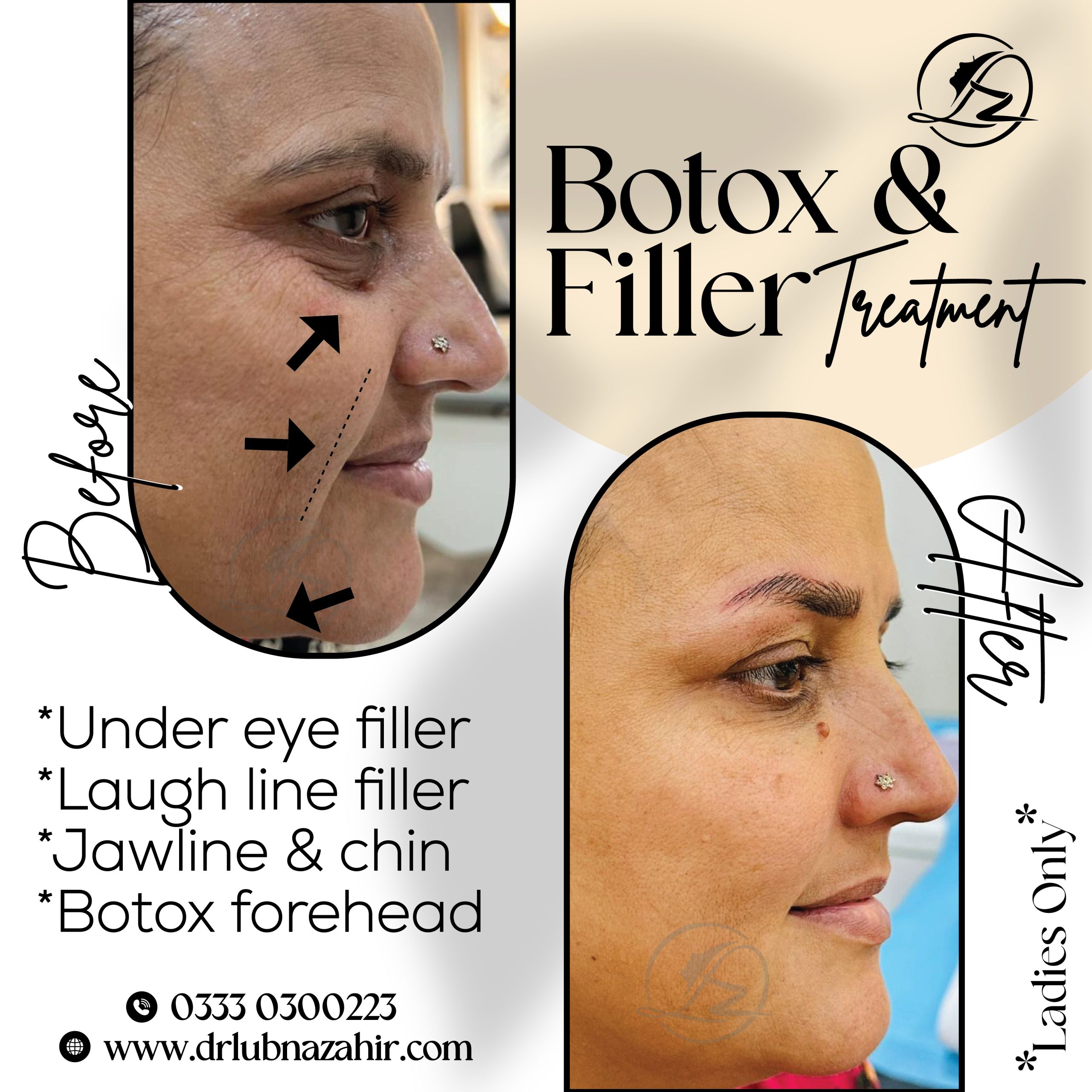 botox and filler in treatment in islamabad