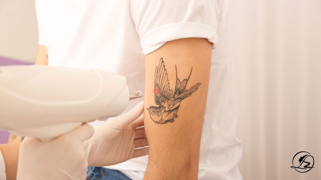 Laser Tattoo Removal