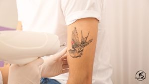 Laser Tattoo Removal