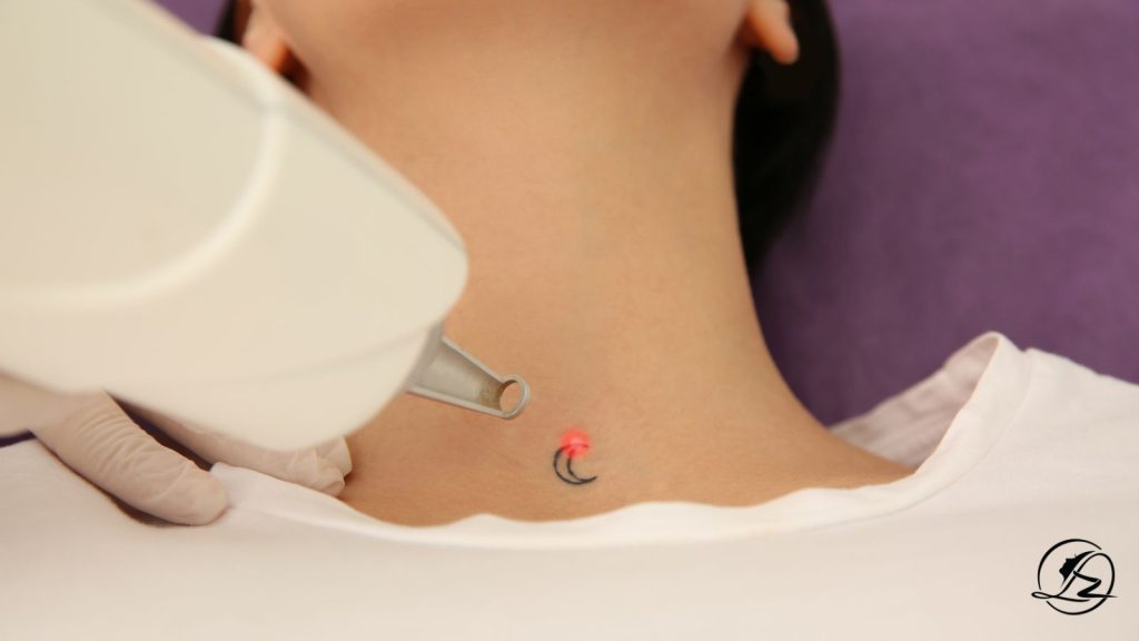 Does Laser Tattoo Removal Work