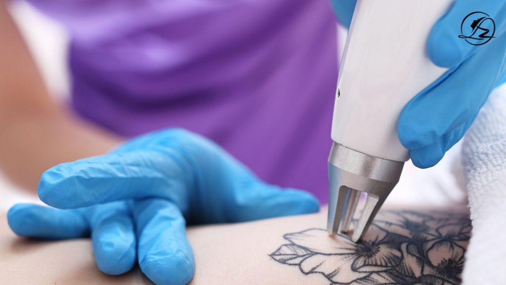 Laser Tattoo Removal in Islamabad