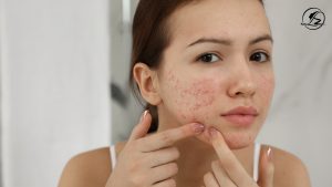 Acne Scars Treatment in Islamabad