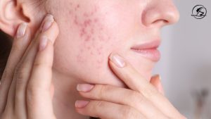 Professional Treatments for Acne Scars