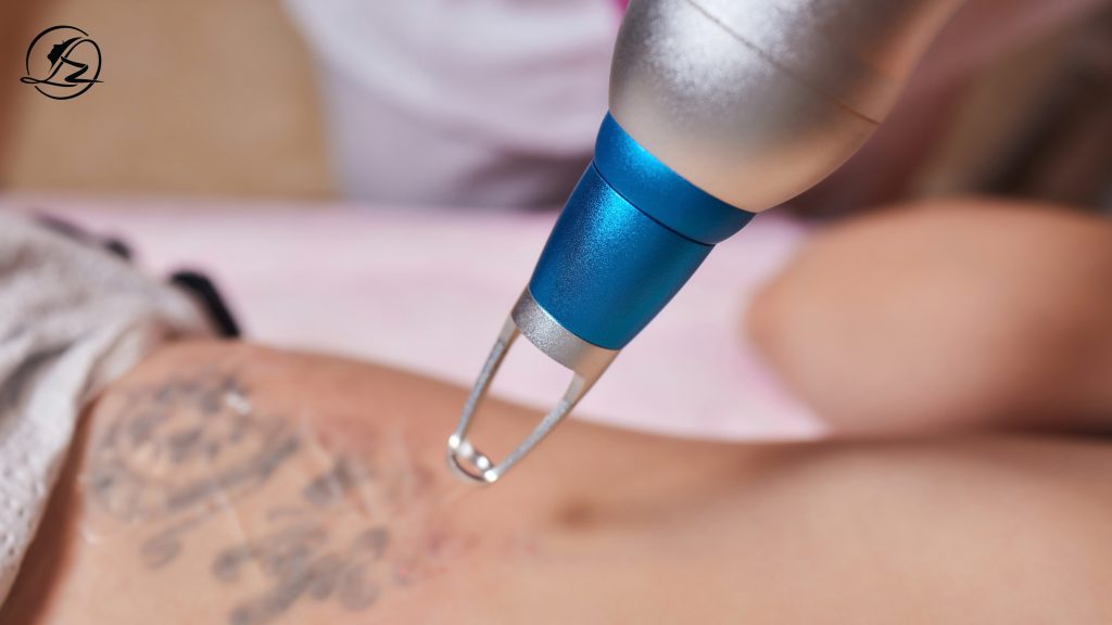 Tattoo removal in islamabad