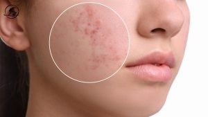 Lifestyle Habits That Help Prevent And Manage Acne