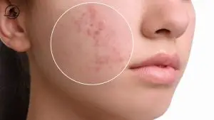 Lifestyle Habits That Help Prevent And Manage Acne